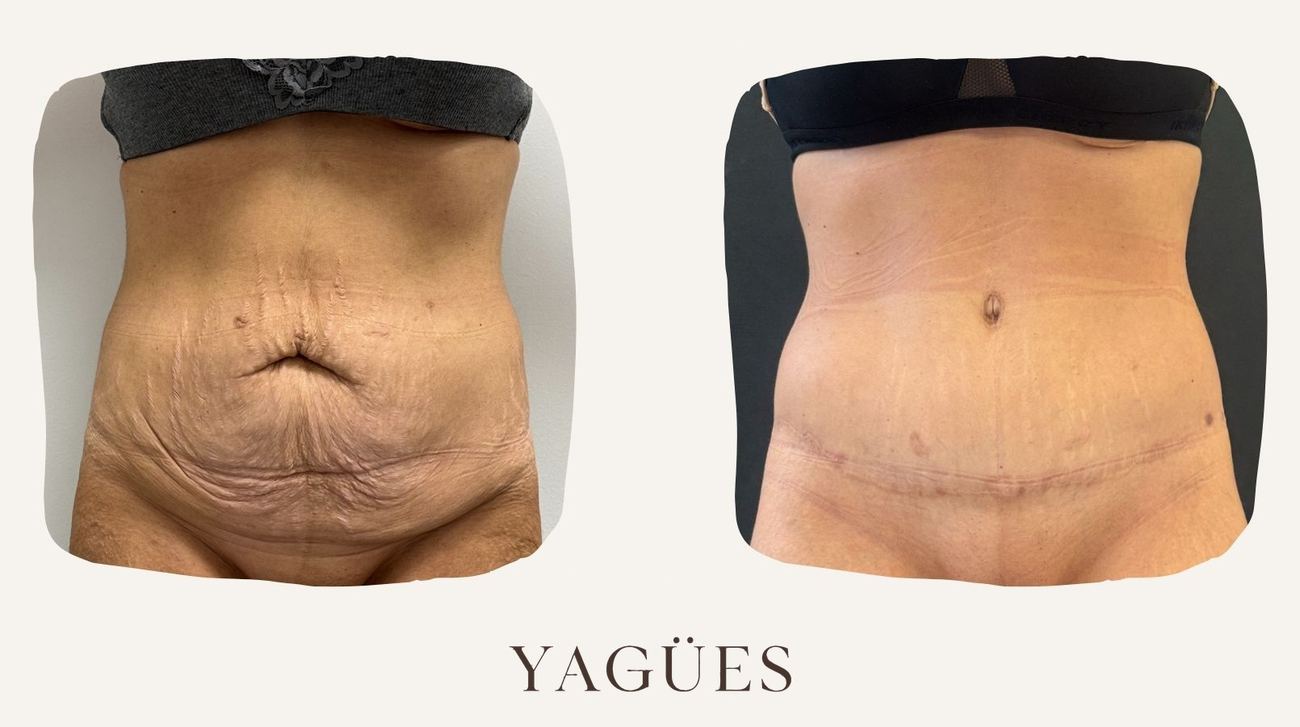 Abdominoplastia: resultado antes y después de una paciente de la Dra. María Yagües en Málaga