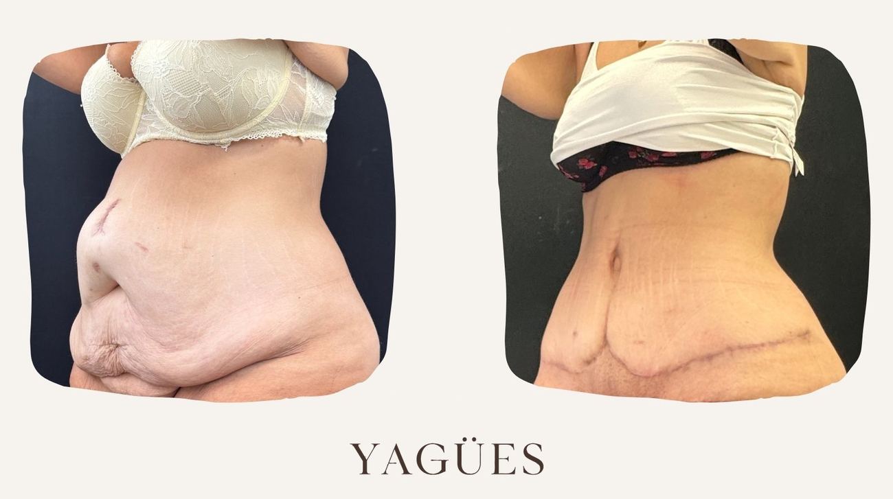 Abdominoplastia: resultado antes y después de una paciente de la Dra. María Yagües en Málaga