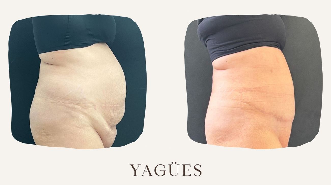 Abdominoplastia: resultado antes y después de una paciente de la Dra. María Yagües en Málaga