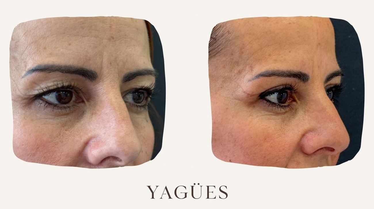 Blefaroplastia: resultado antes y después de una paciente de la Dra. María Yagües en Málaga
