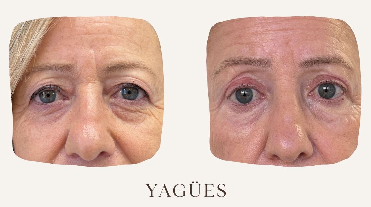 Blefaroplastia: resultado antes y después de una paciente de la Dra. María Yagües en Málaga