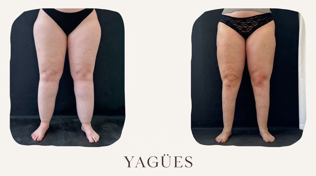 Lipedema: resultado antes y después de una paciente de la Dra. María Yagües en Málaga