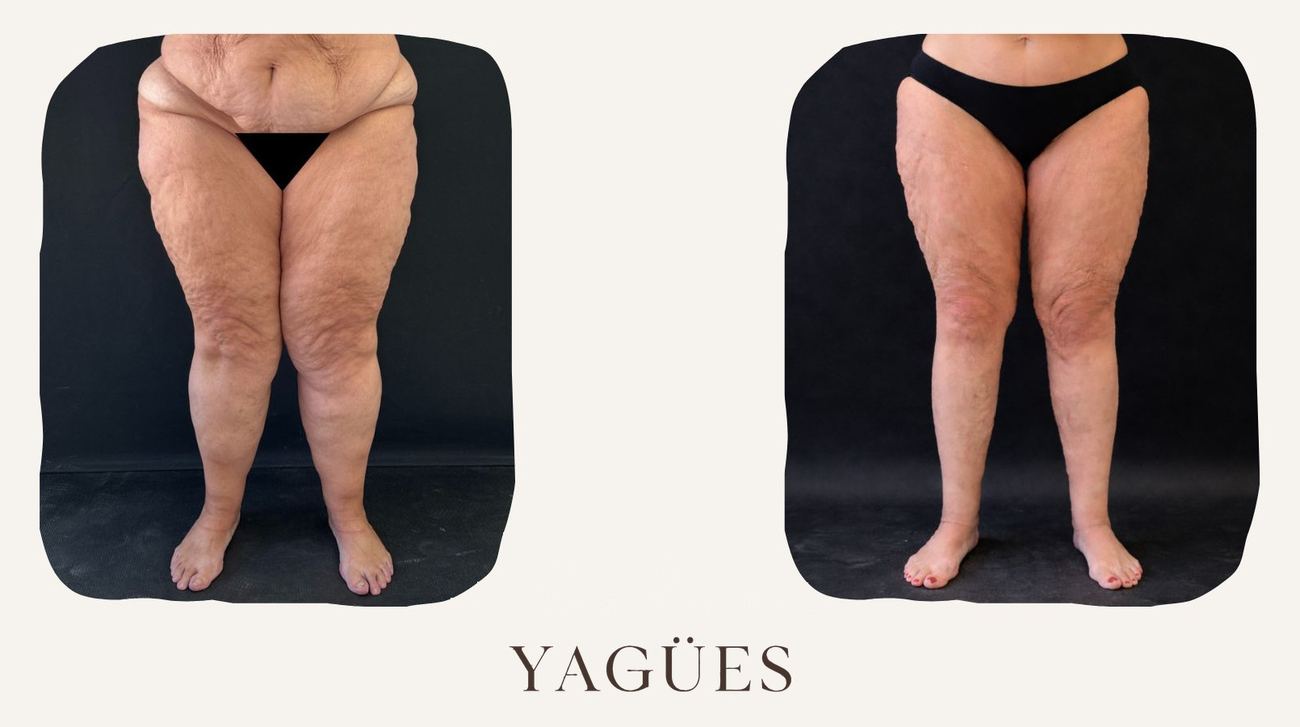 Lipedema: resultado antes y después de una paciente de la Dra. María Yagües en Málaga