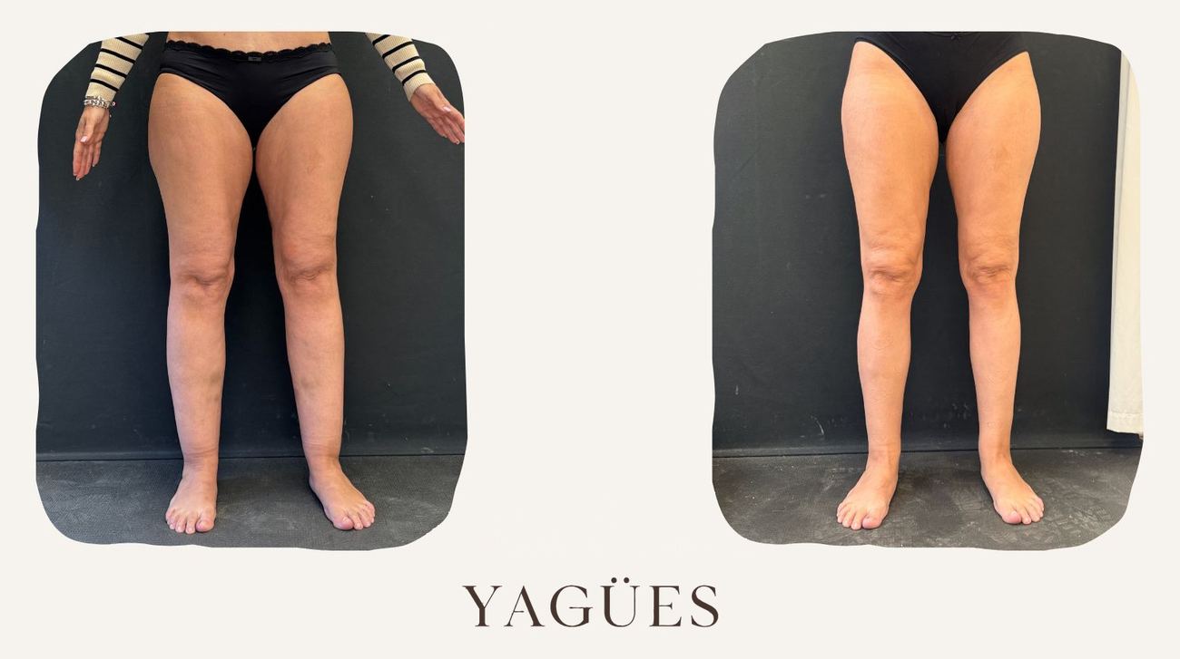 Lipedema: resultado antes y después de una paciente de la Dra. María Yagües en Málaga