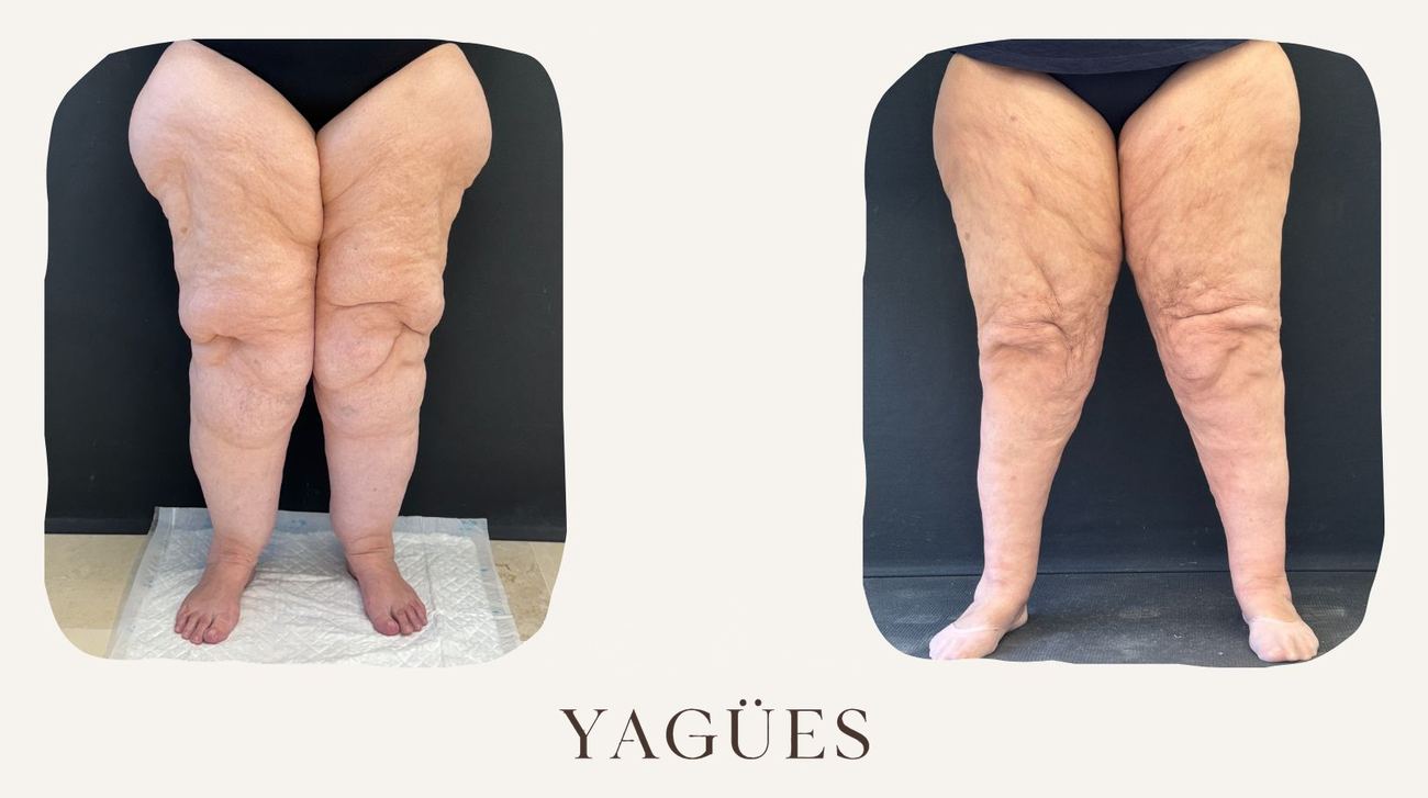 Lipedema: resultado antes y después de una paciente de la Dra. María Yagües en Málaga