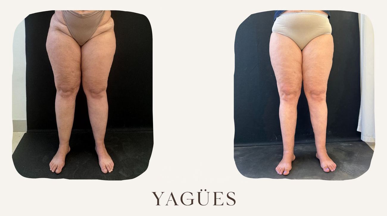 Lipedema: resultado antes y después de una paciente de la Dra. María Yagües en Málaga