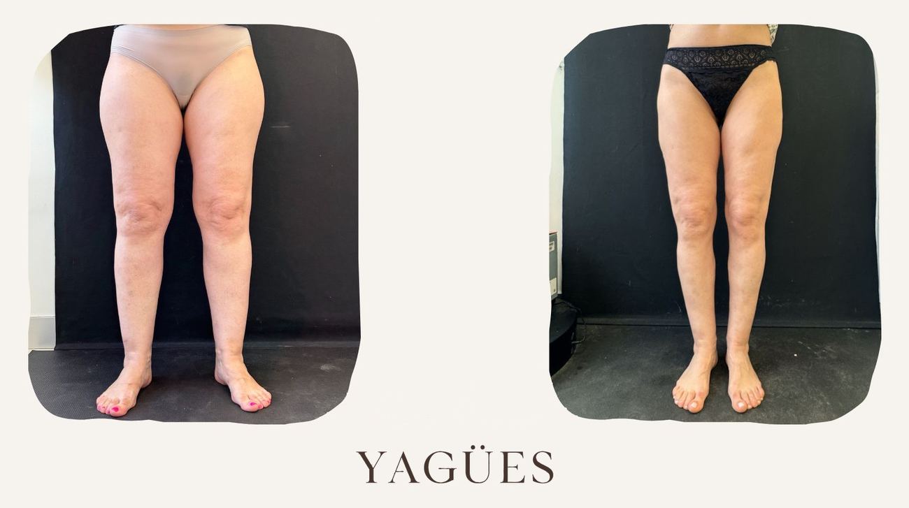 Lipedema: resultado antes y después de una paciente de la Dra. María Yagües en Málaga