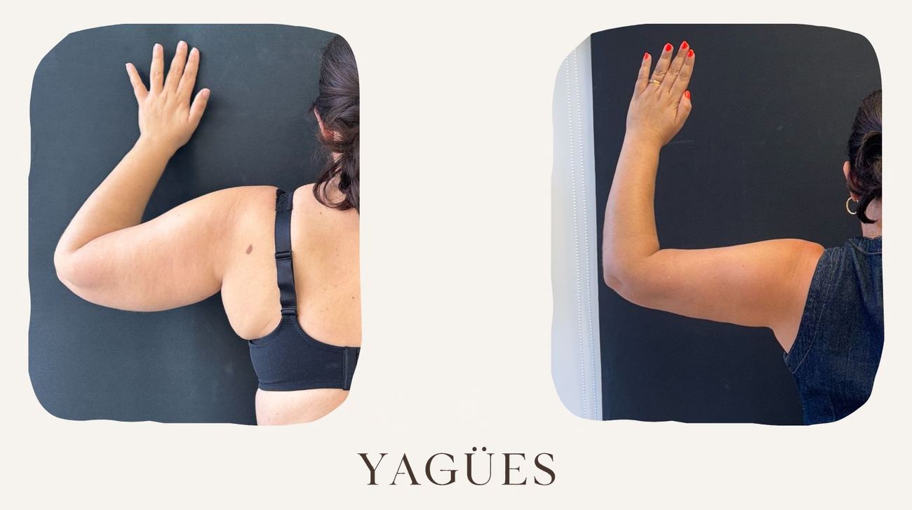 Lipedema: resultado antes y después de una paciente de la Dra. María Yagües en Málaga