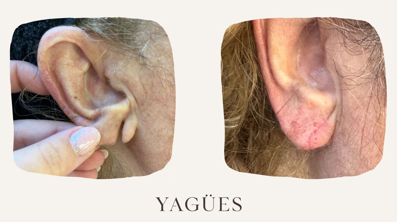 Lobuloplastia: resultado antes y después de una paciente de la Dra. María Yagües en Málaga