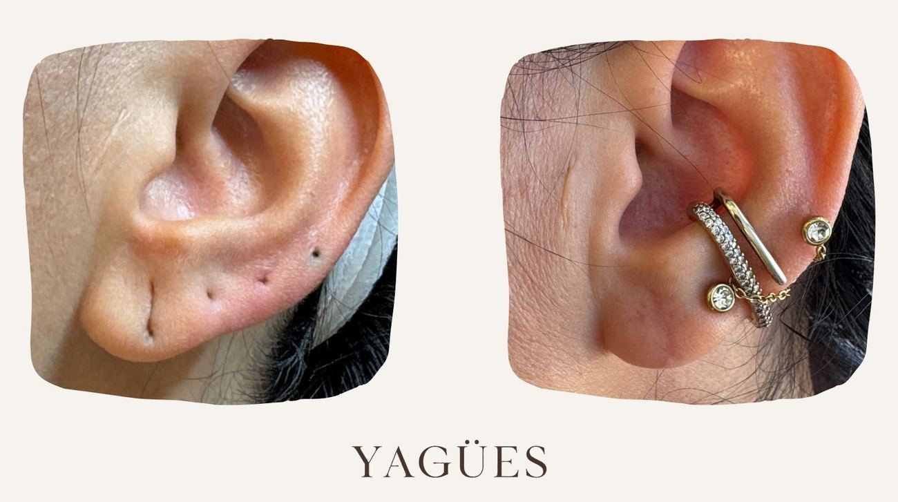 Lobuloplastia: resultado antes y después de una paciente de la Dra. María Yagües en Málaga