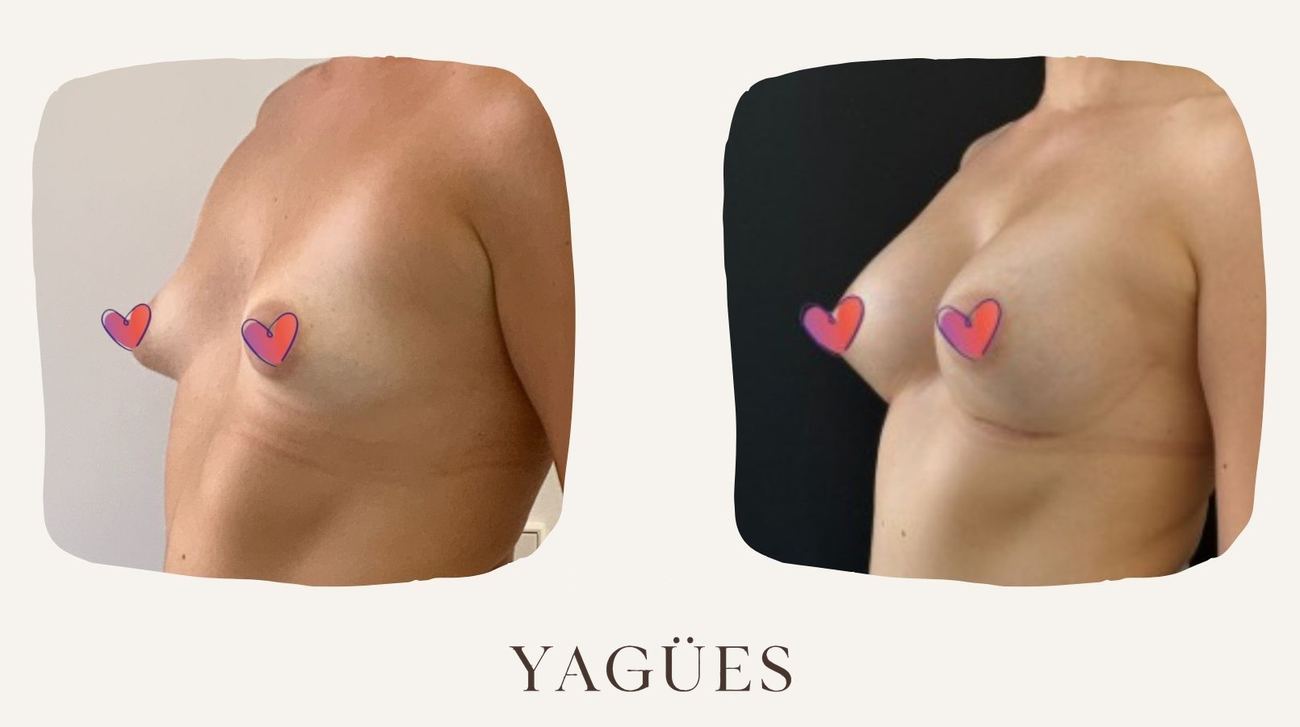 Mamas tuberosas: resultado antes y después de una paciente de la Dra. María Yagües en Málaga