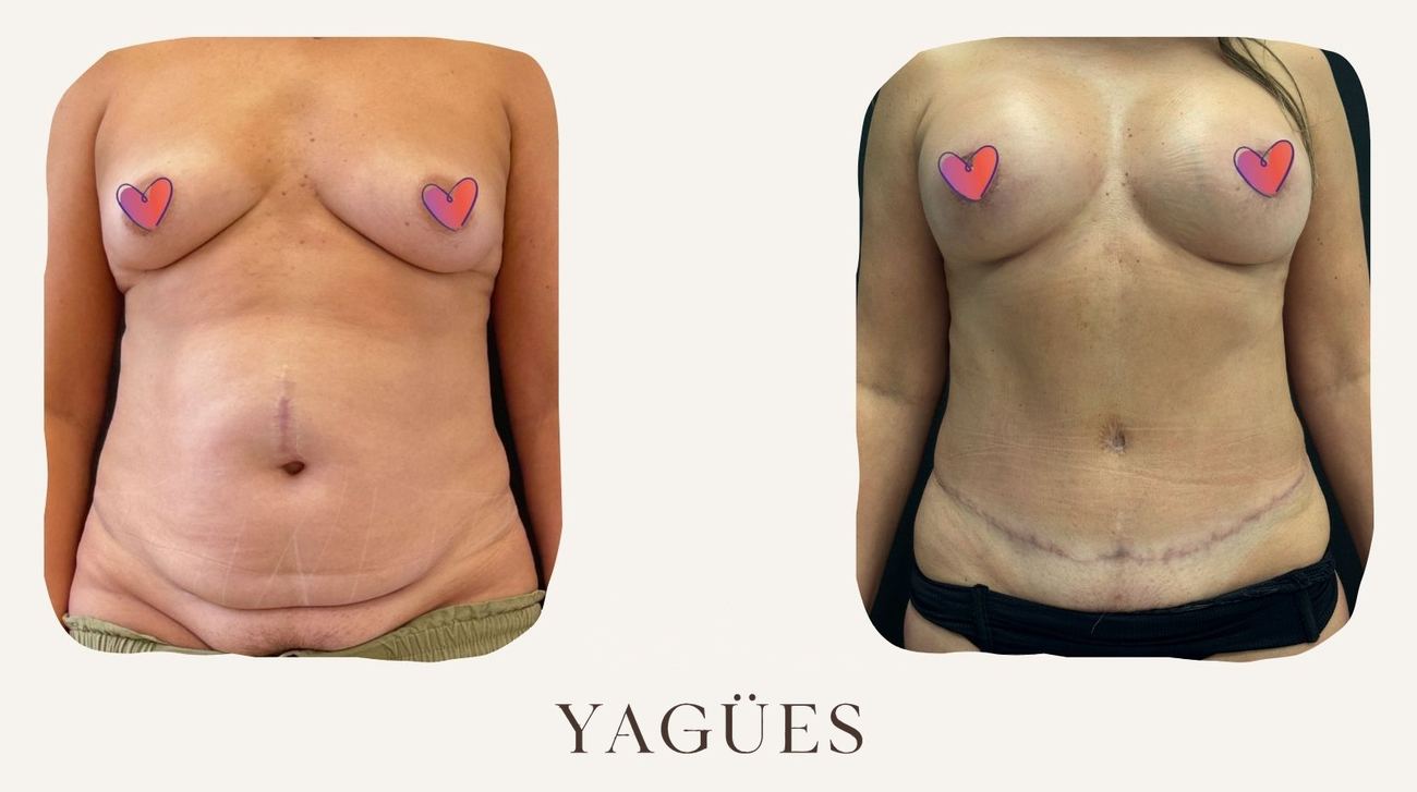 Mommy makeover: resultado antes y después de una paciente de la Dra. María Yagües en Málaga