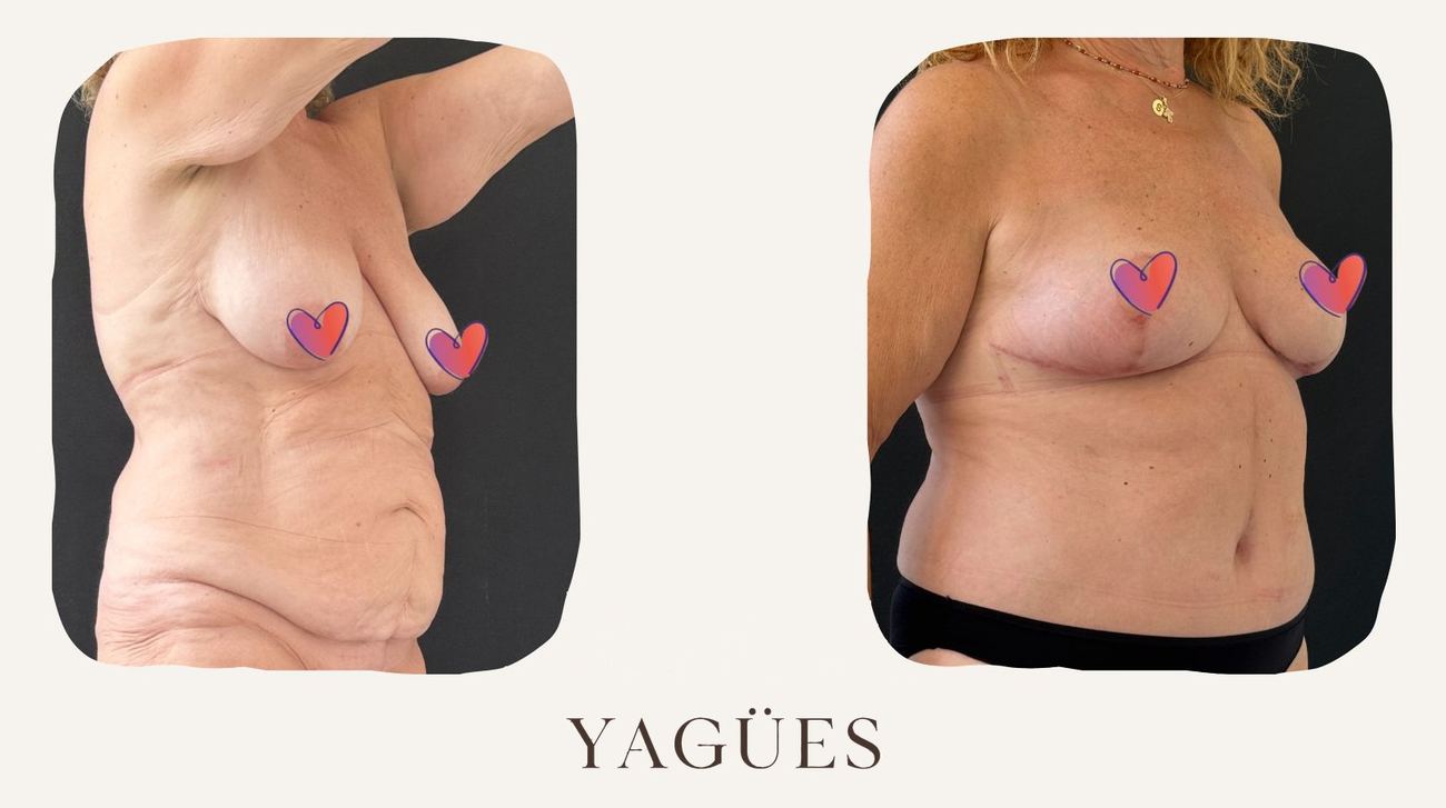 Mommy makeover: resultado antes y después de una paciente de la Dra. María Yagües en Málaga