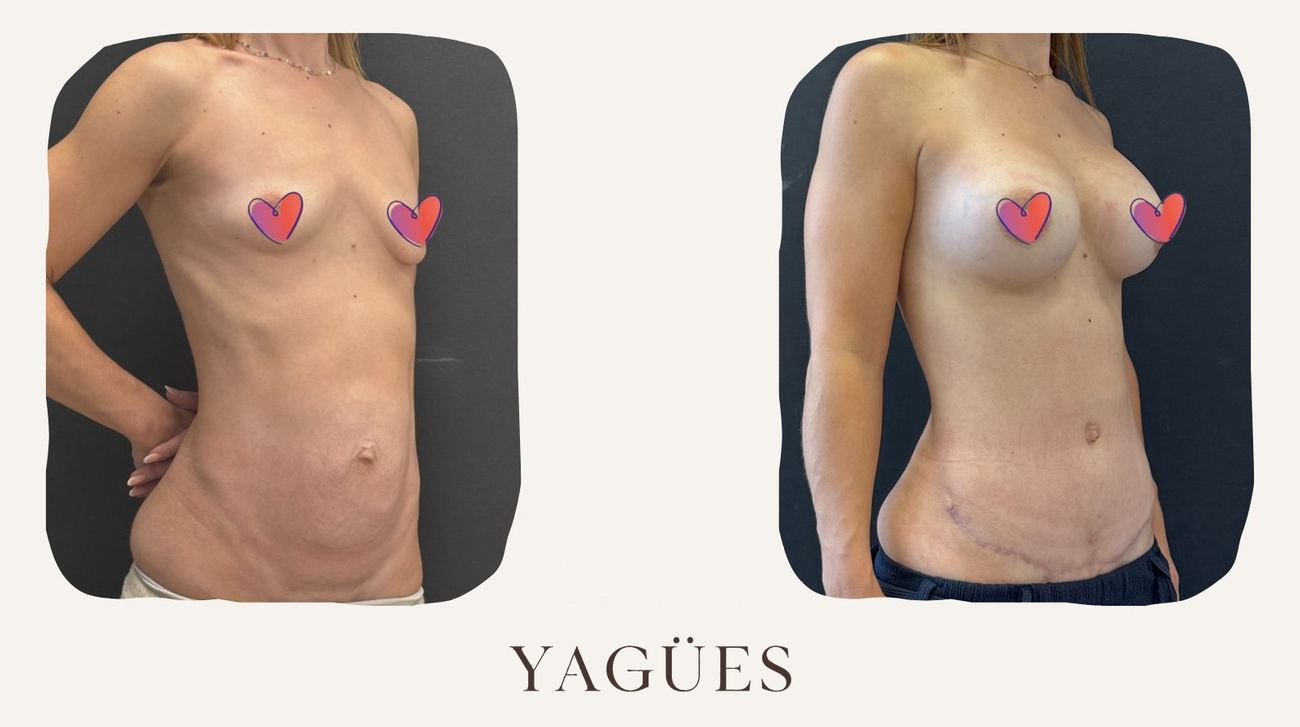 Mommy makeover: resultado antes y después de una paciente de la Dra. María Yagües en Málaga