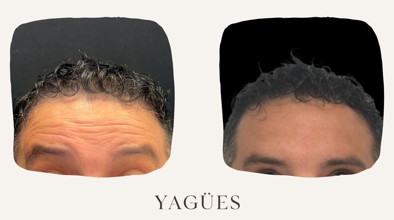 Neuromoduladores: resultado antes y después de una paciente de la Dra. María Yagües en Málaga