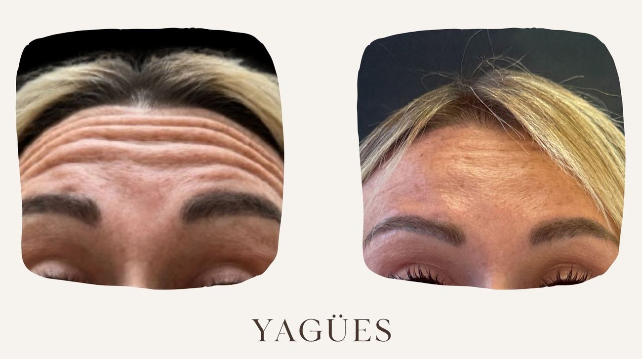 Neuromoduladores: resultado antes y después de una paciente de la Dra. María Yagües en Málaga