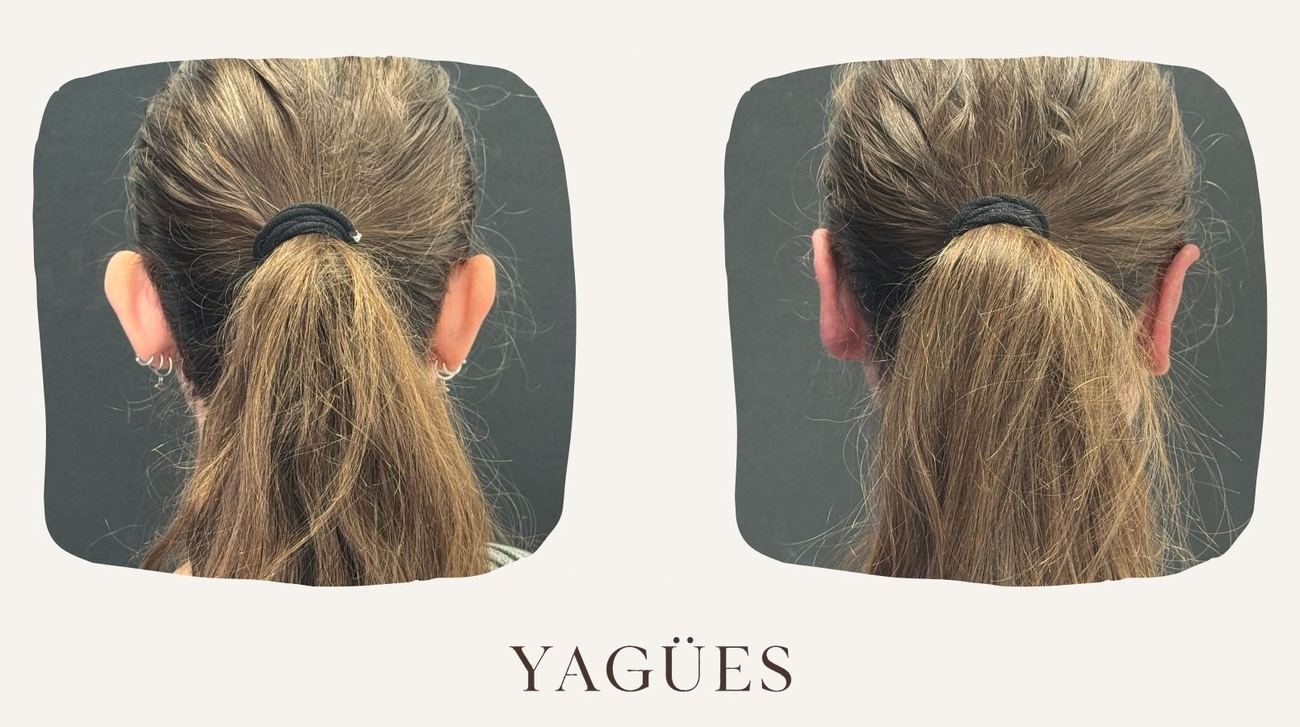 Otoplastia: resultado antes y después de una paciente de la Dra. María Yagües en Málaga