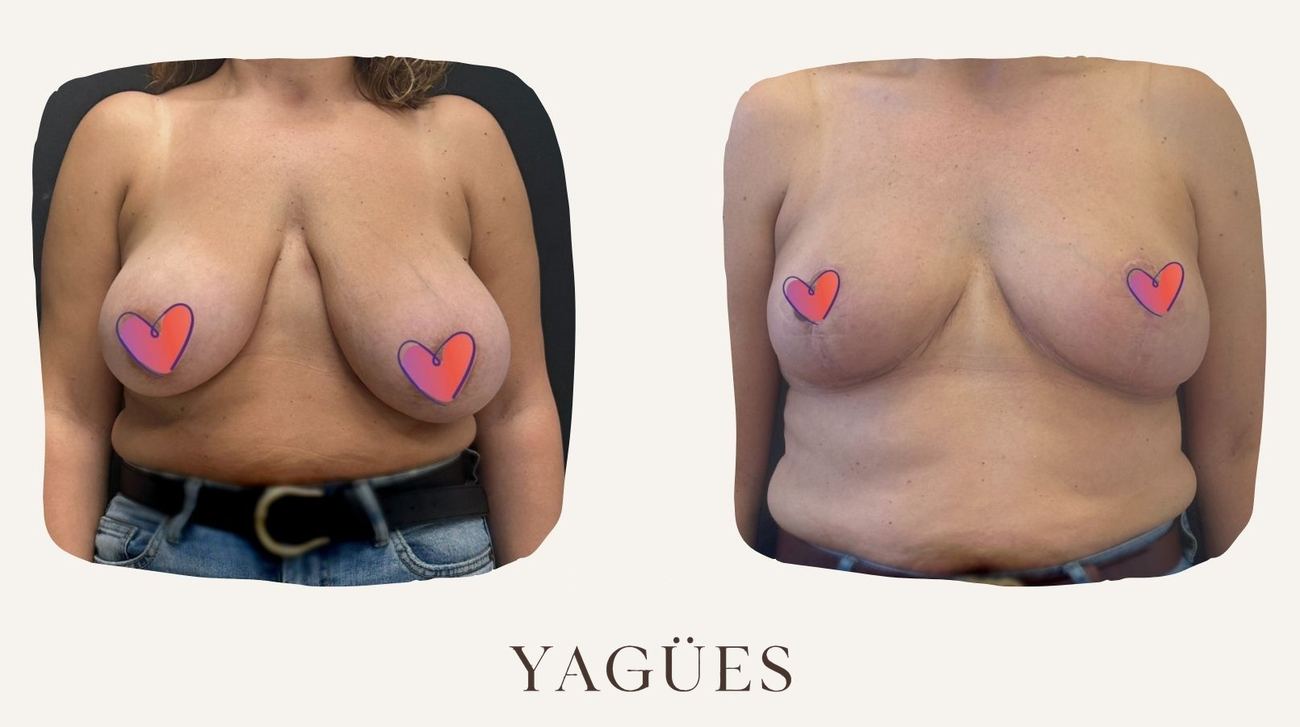 Reducción mamaria: resultado antes y después de una paciente de la Dra. María Yagües en Málaga